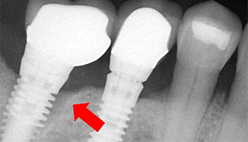 tampa implant dentist
